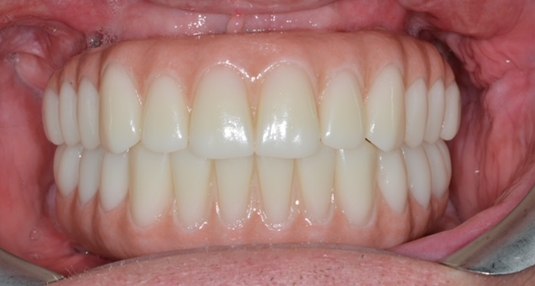 dental implants  portadown