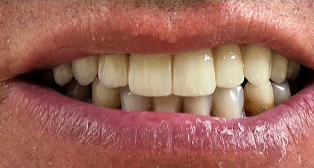 dental implants  portadown
