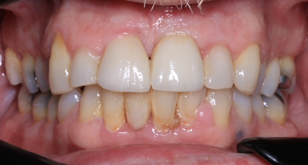 dental implants portadown
