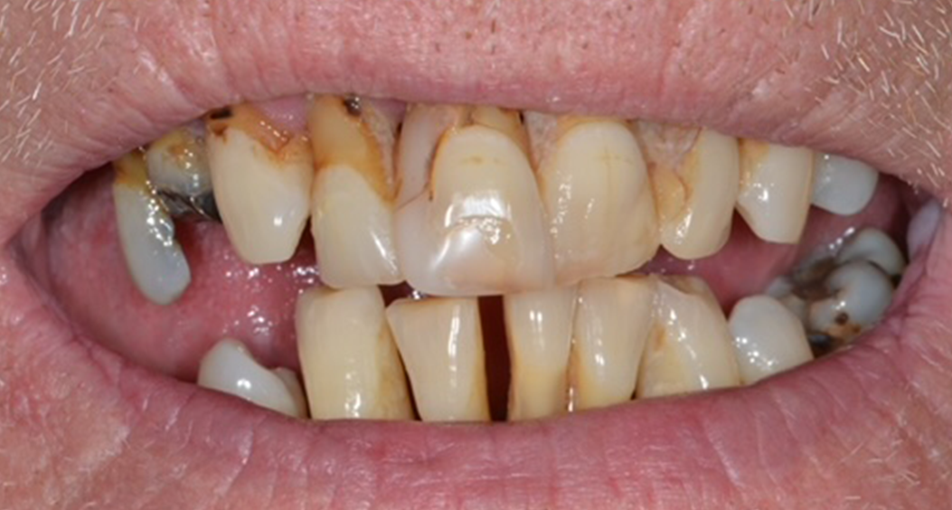dental implants william street dental