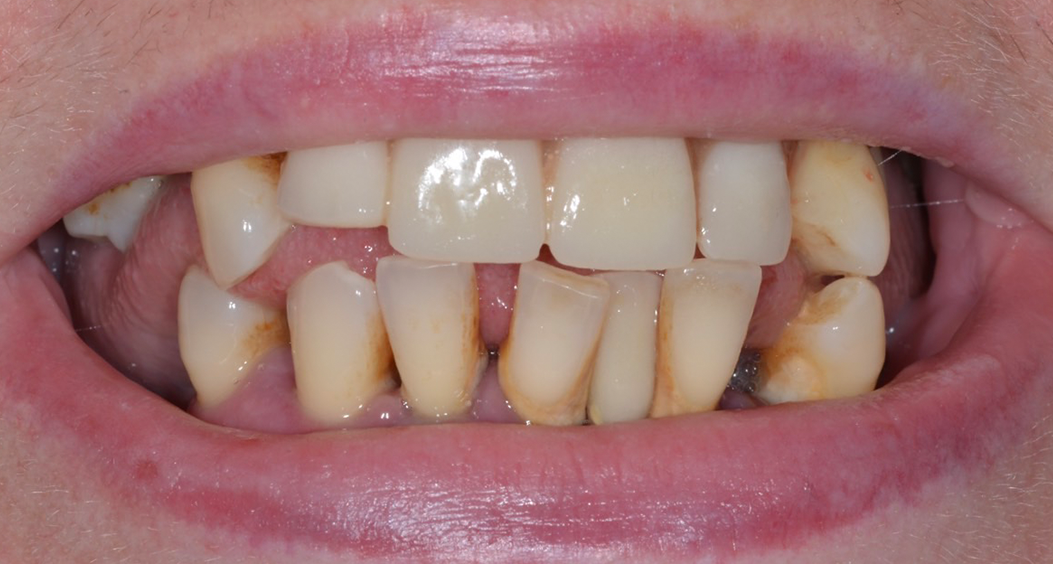 dental implants william street dental