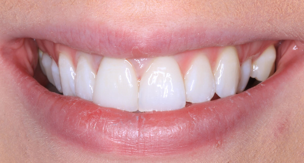 Tooth Whitening in Portadown - William Street Dental - Dentist in ...